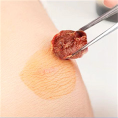 Medical Iodophor cotton balls-Easy to operate