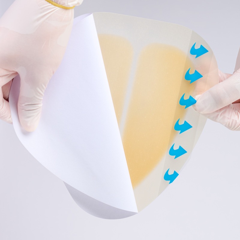 Sacral hydrocolloid dressing, size 15 cm x 18 cm, aesidhve bordered hydrocolloid bandage