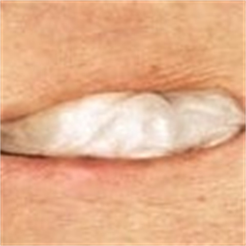 Alginate Dressing In Roll, size 2 cm x 30 cm, Advanced Wound Care Solution, Suitable for cuts and lacerations, Post Surgical Wounds.