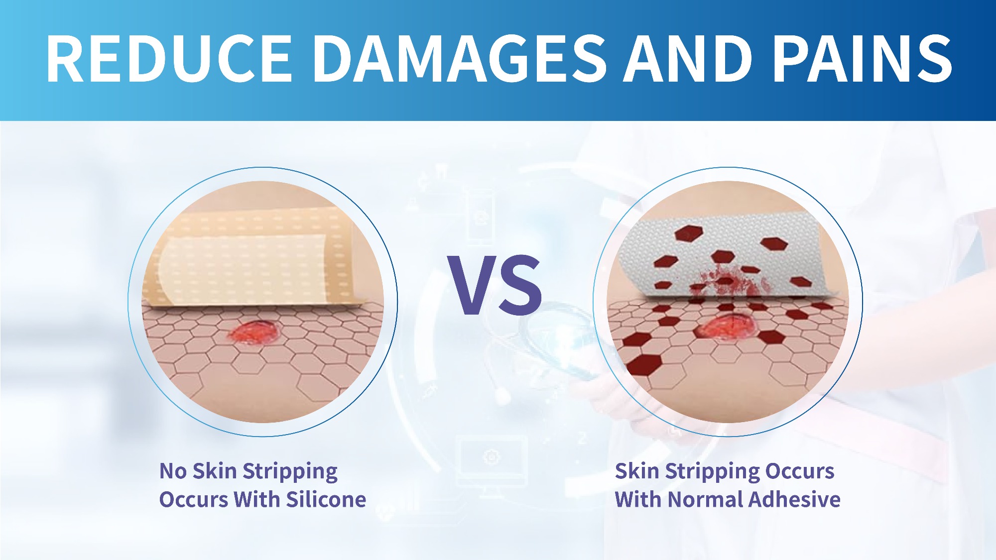 Alginate Wound Dressings Versus Foam Dressings