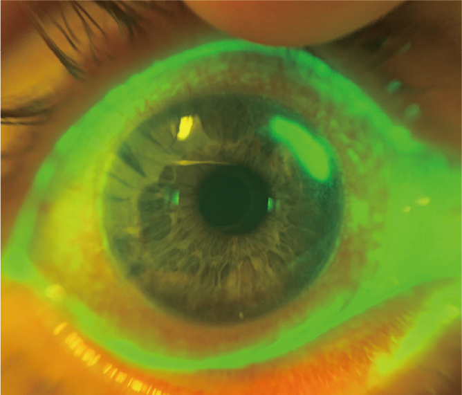 Eye Imaging Adaptor QuikVue Plus VPA-200