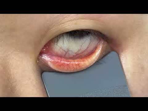 Eyelid Everter LidVue VEE-100
