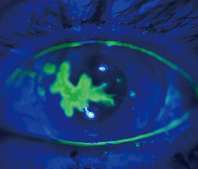 Eye Imaging Adaptor QuikVue Plus VPA-200