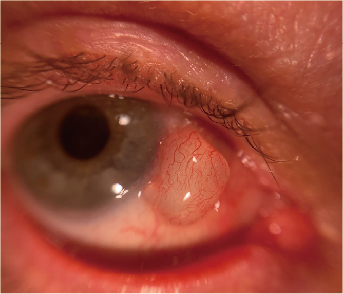 Eye Imaging Adaptor QuikVue Plus VPA-200