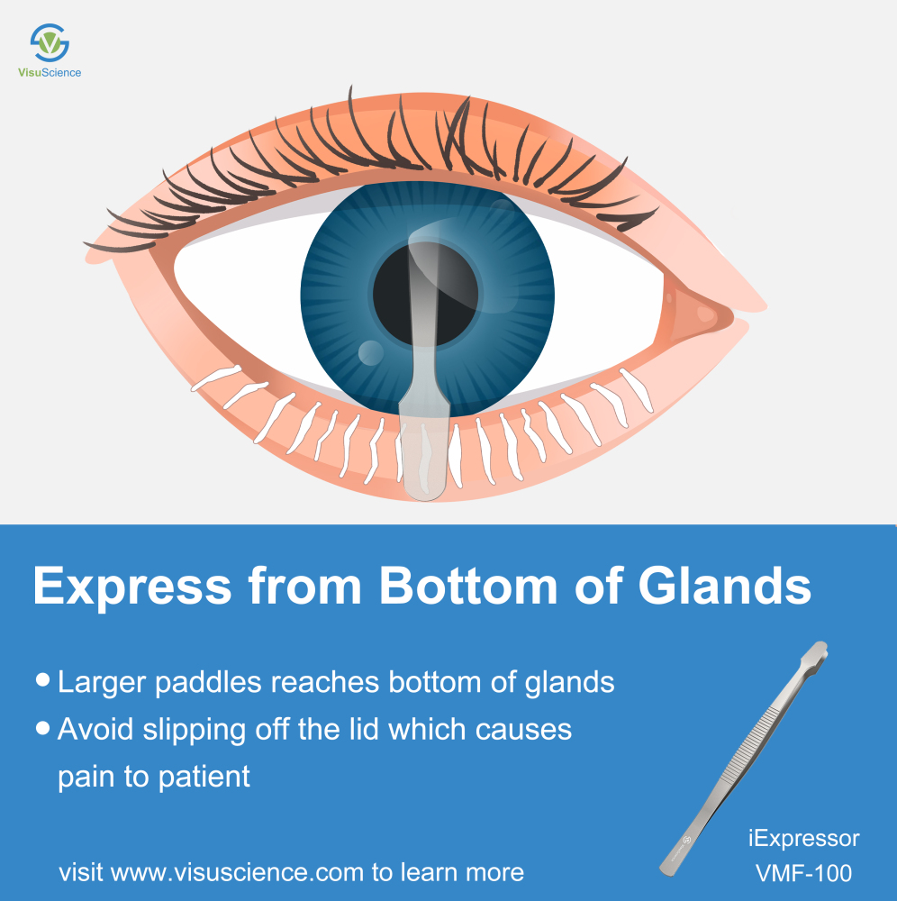 iExpressor meibomian gland expression forcep VMF-100