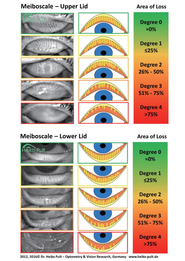 Free Dry Eye Educational Brochures