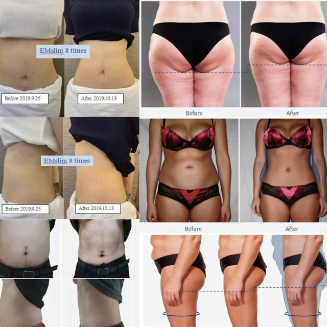 Portable EMSLIM Muscle Building Machine | 13 Tesla HIFEM | CE Certified,emmalaser,EMSLIM Ultrasonic Fat Burner | Emmalaser – America's leading brand of fat loss technology