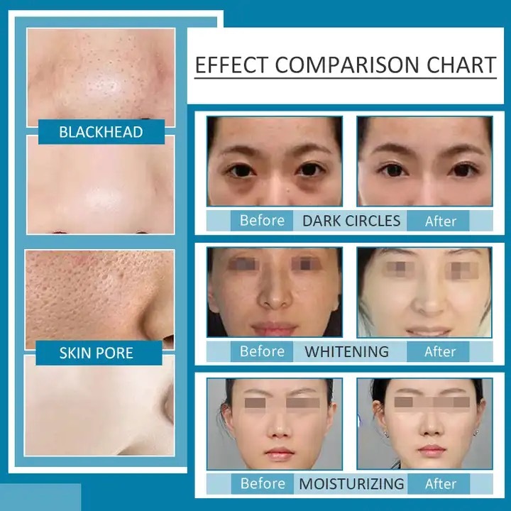 Multifunctional Hydro Dermabrasion Machine – Deep Cleaning & Collagen Rejuvenation,emmalaser,Multifunctional Hydro Dermabrasion Machine – Deep Cleaning & Collagen Rejuvenation