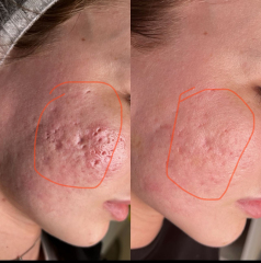 Best Morphues8 RF Microneedling Device For Sale: Advanced Skin Rejuvenation & Tightening Solution,emmalaser,Best Morphues8 RF Microneedling Device For Sale: Advanced Skin Rejuvenation & Tightening Solution