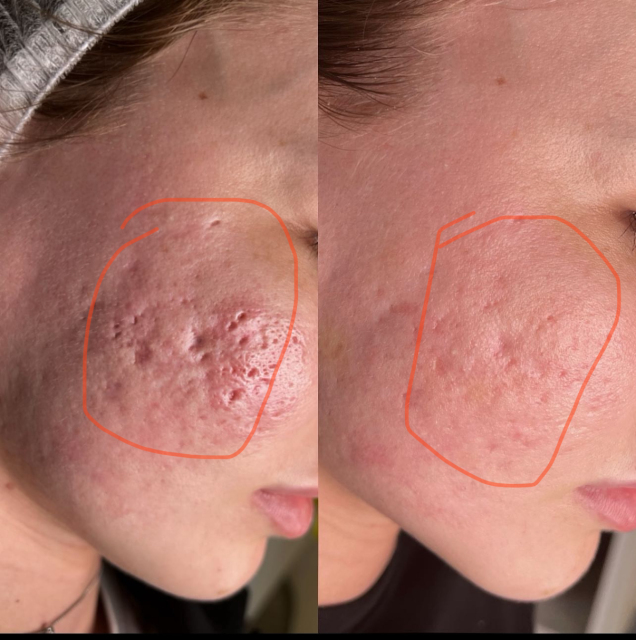 Best Morphues8 RF Microneedling Device For Sale: Advanced Skin Rejuvenation & Tightening Solution,emmalaser,Best Morphues8 RF Microneedling Device For Sale: Advanced Skin Rejuvenation & Tightening Solution