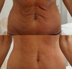 Best Morphues8 RF Microneedling Device For Sale: Advanced Skin Rejuvenation & Tightening Solution,emmalaser,Best Morphues8 RF Microneedling Device For Sale: Advanced Skin Rejuvenation & Tightening Solution