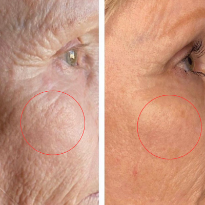 Cold Plasma Machine – Advanced Non-Invasive Skin Regeneration & Sterilization,emmalaser,Cold Plasma Machine – Advanced Non-Invasive Skin Regeneration & Sterilization