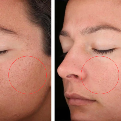 Before / After — T-zone