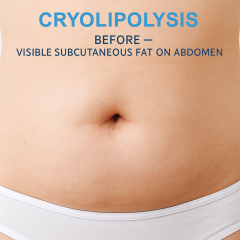 360 Cryolipolysis Fat Freezing,emmalaser,360 Cryolipolysis Fat Freezing