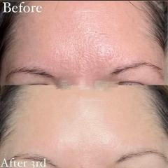 Coolplasmo Vertical Cold Plasma Machine | Professional Skin Regeneration Device,emmalaser,Coolplasmo Vertical Cold Plasma Machine | Professional Skin Regeneration Device