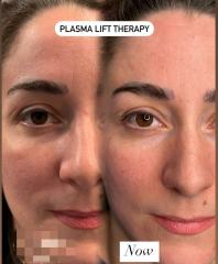 Coolplasmo Vertical Cold Plasma Machine | Professional Skin Regeneration Device,emmalaser,Coolplasmo Vertical Cold Plasma Machine | Professional Skin Regeneration Device