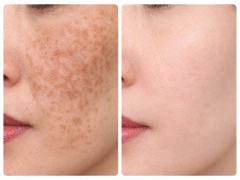 Picosecond 1064nm 532nm 755nm Tattoo Removal Machine: Revolutionizing Aesthetic Dermatology,emmalaser,Picosecond 1064nm 532nm 755nm Tattoo Removal Machine: Revolutionizing Aesthetic Dermatology