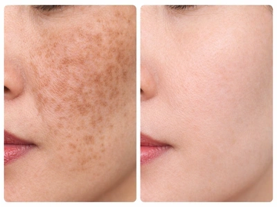 Picosecond 1064nm 532nm 755nm Tattoo Removal Machine: Revolutionizing Aesthetic Dermatology,emmalaser,Picosecond 1064nm 532nm 755nm Tattoo Removal Machine: Revolutionizing Aesthetic Dermatology