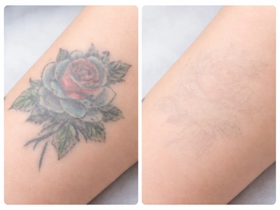 Picosecond 1064nm 532nm 755nm Tattoo Removal Machine: Revolutionizing Aesthetic Dermatology,emmalaser,Picosecond 1064nm 532nm 755nm Tattoo Removal Machine: Revolutionizing Aesthetic Dermatology