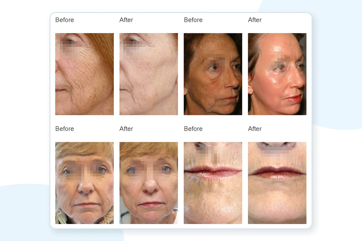 FDA Approved CO2 Fractional Laser Machine for Clinics | Emmalaser,emmalaser,FDA Approved CO2 Fractional Laser Machine for Clinics | Emmalaser