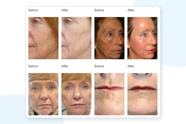 FDA Approved CO2 Fractional Laser Machine for Clinics | Emmalaser,emmalaser,FDA Approved CO2 Fractional Laser Machine for Clinics | Emmalaser
