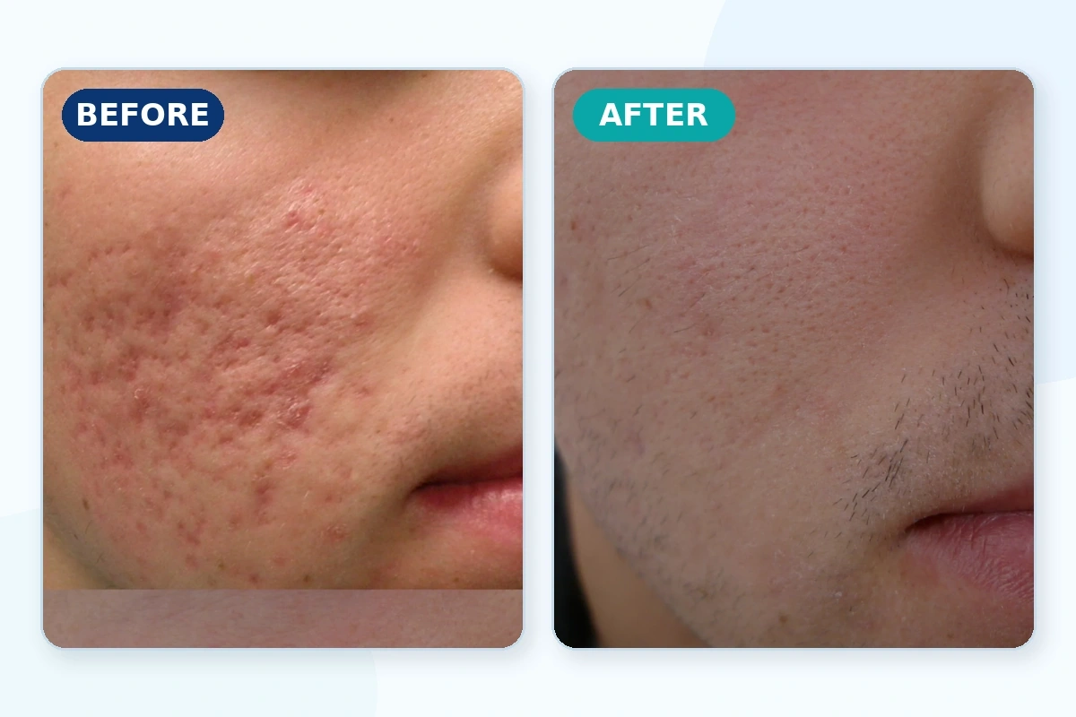 FDA Approved CO2 Fractional Laser Machine for Clinics | Emmalaser,emmalaser,FDA Approved CO2 Fractional Laser Machine for Clinics | Emmalaser