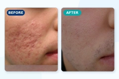 FDA Approved CO2 Fractional Laser Machine for Clinics | Emmalaser,emmalaser,FDA Approved CO2 Fractional Laser Machine for Clinics | Emmalaser