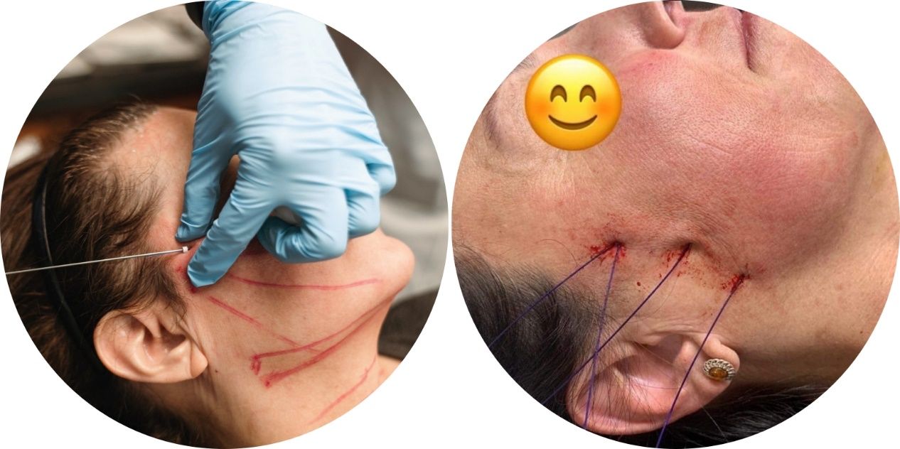 PDO-Cog Lift Thread 14 74cc