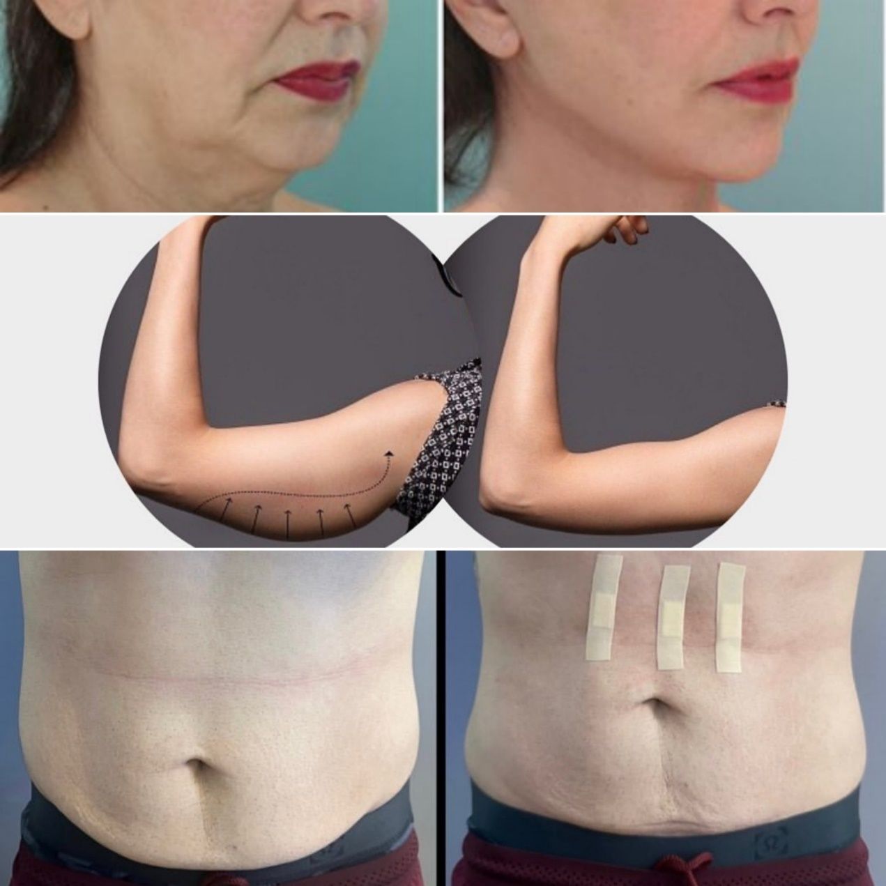 PDO-Cog Lift Thread 15 A625