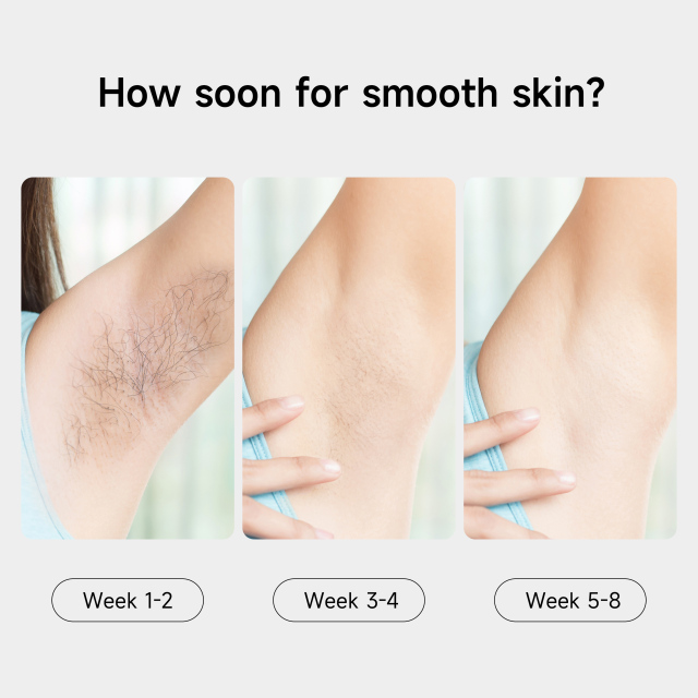 QIZHE Custom IPL Hair Removal Machine – Portable Beauty Device for Home Use
