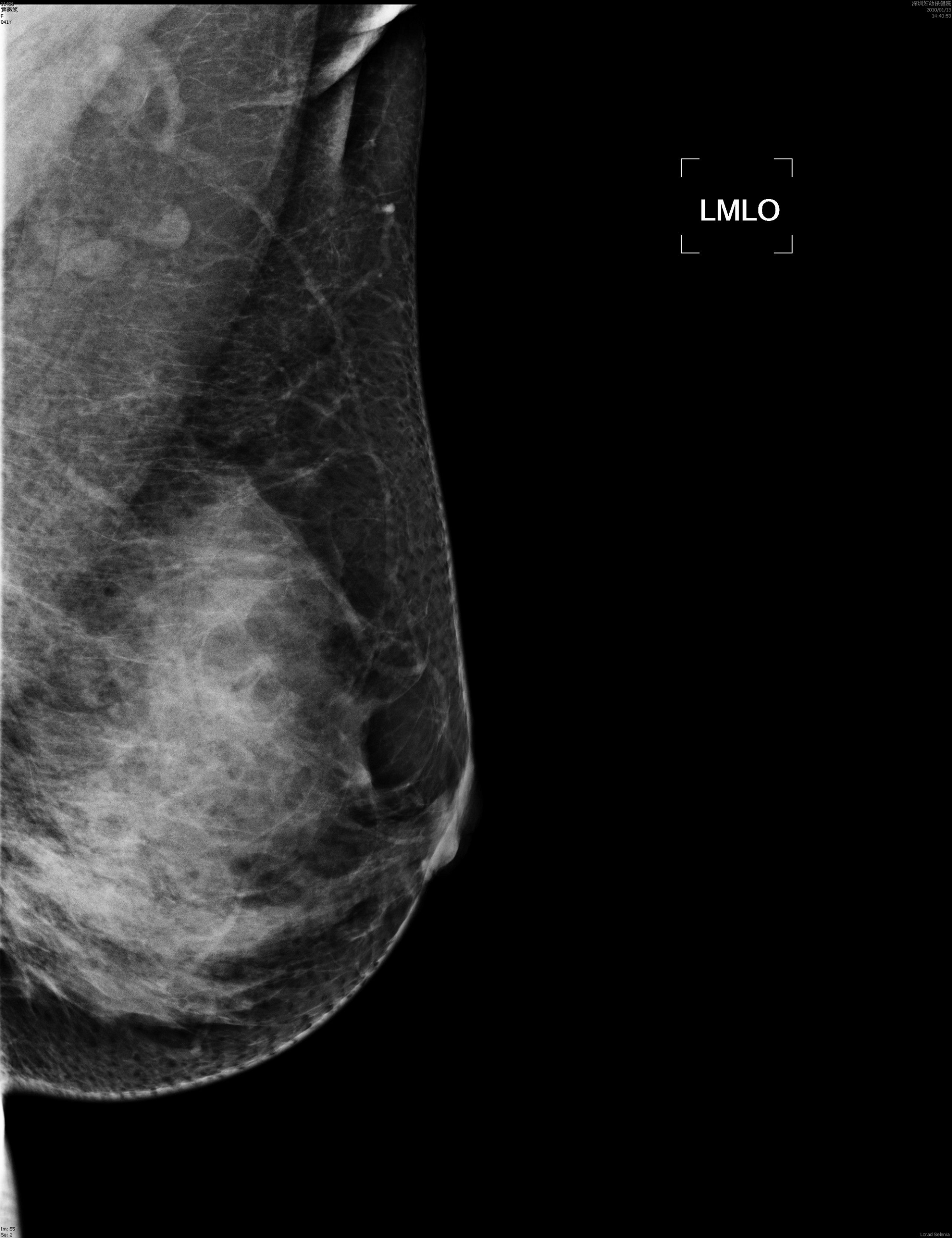 INM-5kW Digital Mammography X-ray System