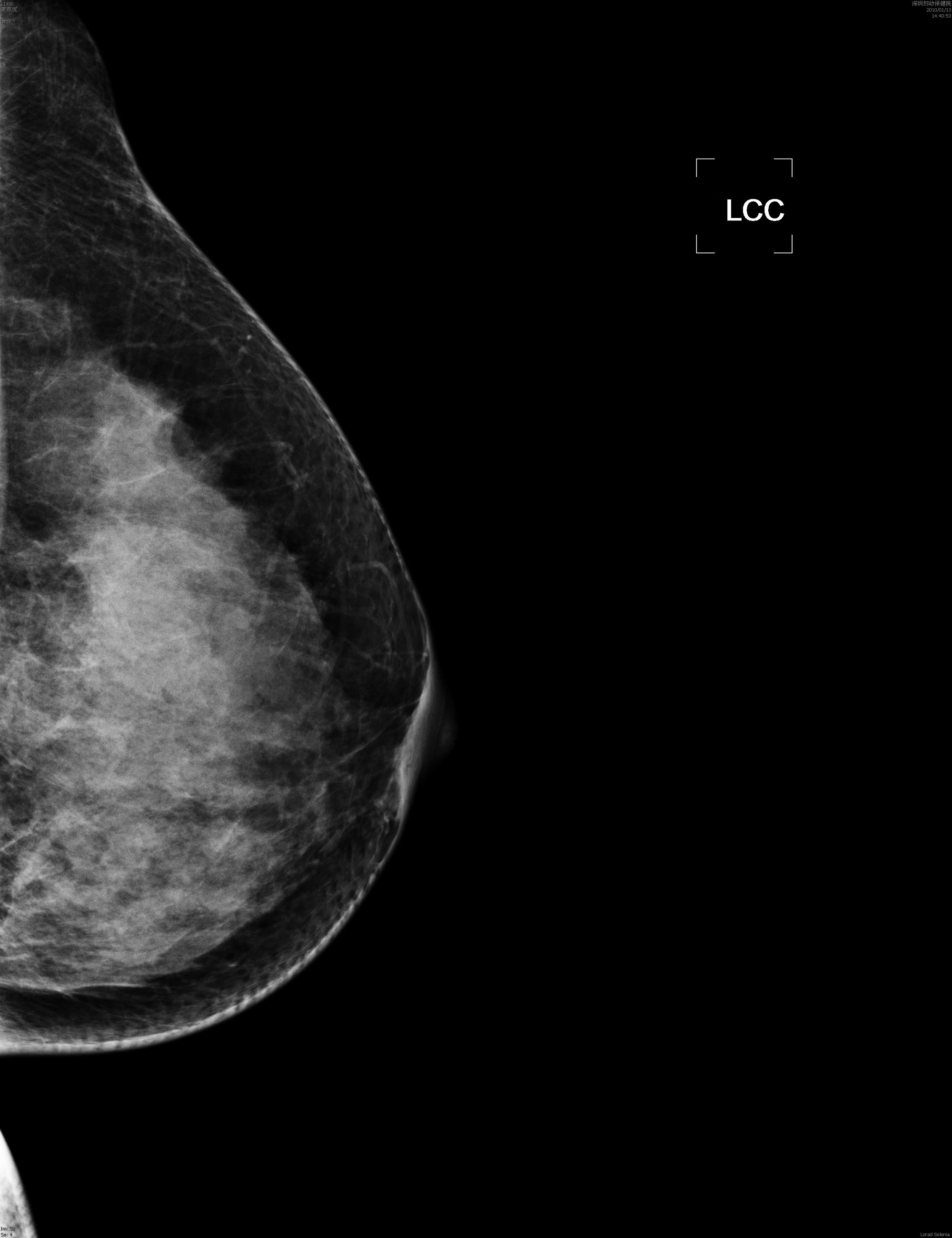 INM-5kW Digital Mammography X-ray System