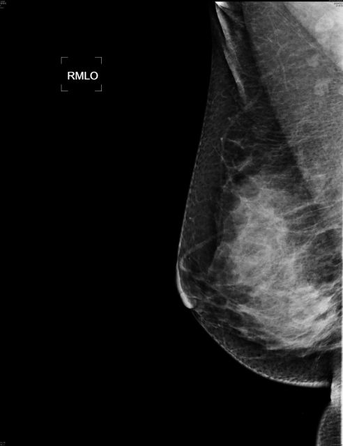 INM-5kW Digital Mammography X-ray System