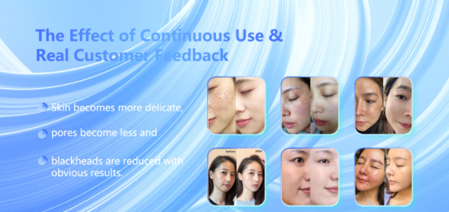 New Design skin Clean acne removal hydra dermabrasion machine Oxygen Hydro dermabrasion Facial Machine