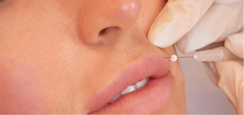 Korea Beauty Anti-Aging Filling Absorbable Sharp Needle 26g 27g 29g 30g Face Lifting Smooth Mono Pdo Thread Lift