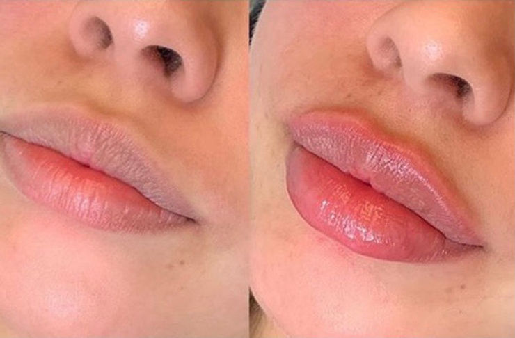 24mg/ml Fine Line Facial Wrinkles Lips Injection Ha Injectable Dermal Filler Cross Linked Hyaluronic Acid Gel