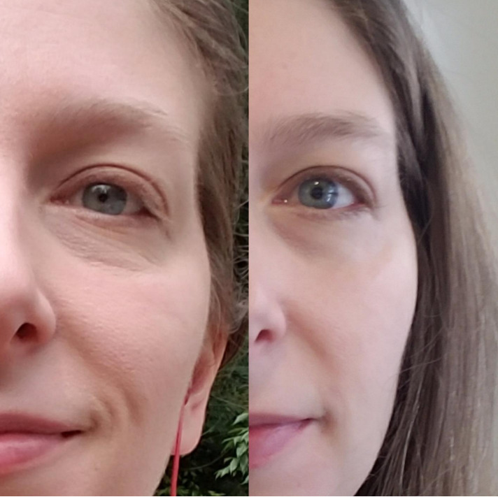 24mg/ml Fine Line Facial Wrinkles Lips Injection Ha Injectable Dermal Filler Cross Linked Hyaluronic Acid Gel