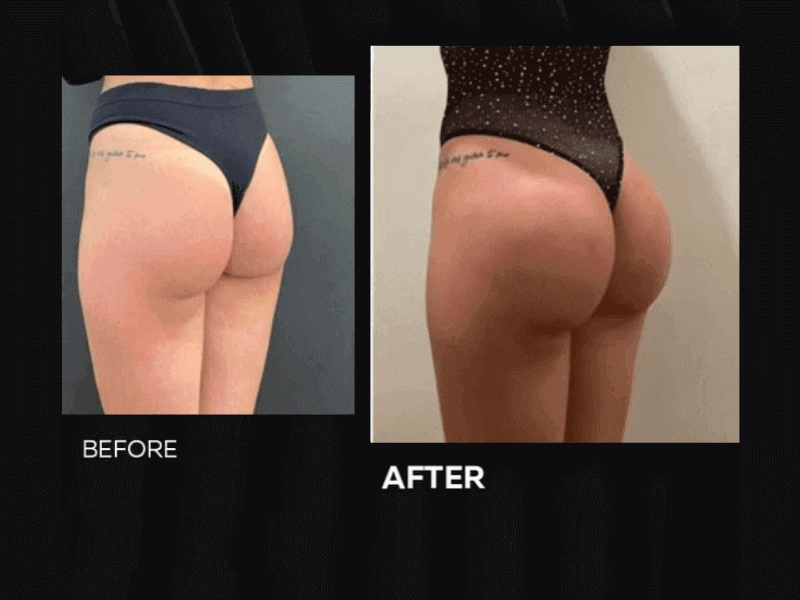 24mg/ml Ultra Large Molecular Particles Ultra Deep Breast Buttock Injection Ha Injectable  Hyaluronic Acid Gel Dermal Filler