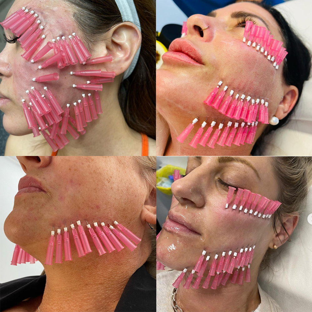 Pcl Thread 360 ° Cog Sharp Blunt Cannula V Line Face Shaping Lifting Pcl Threads For Face Nose Eye Body Lifting Thread