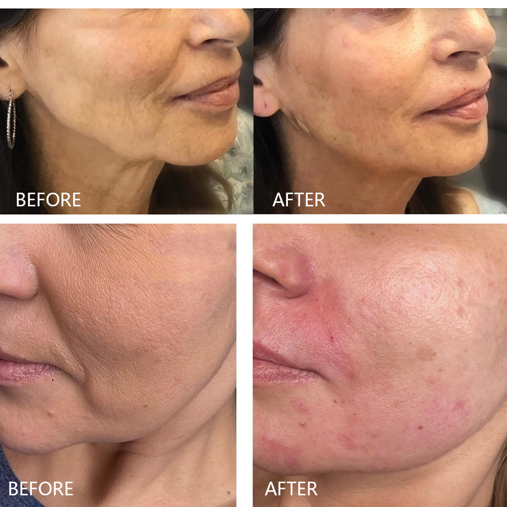 Pcl Thread 360 ° Cog Sharp Blunt Cannula V Line Face Shaping Lifting Pcl Threads For Face Nose Eye Body Lifting Thread