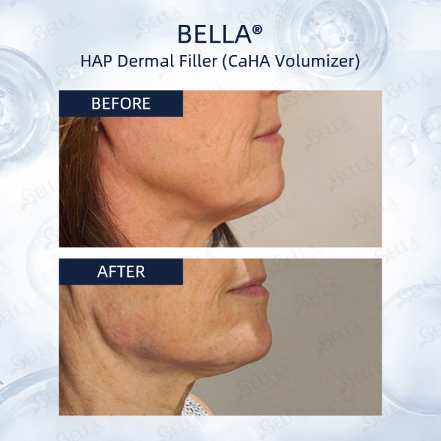 Bella HAP 1ml/syringe