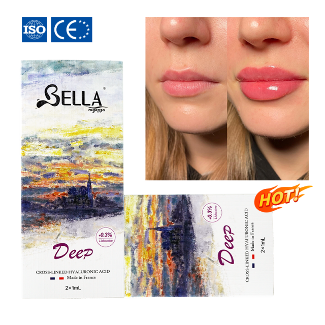 BELLA Lip Filler – Hyaluronic Acid Lip Enhancement