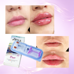 BELLA Lip Filler – Hyaluronic Acid Lip Enhancement