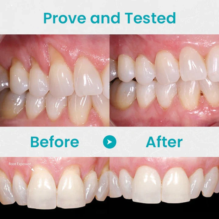 🔥Last Day Promotion 49% OFF-NESLEMY™ Gum Shield Therapy Gel（Buy 2 Free Shipping）