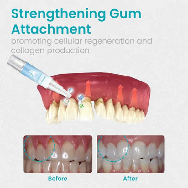🔥Last Day Promotion 49% OFF-NESLEMY™ Gum Shield Therapy Gel（Buy 2 Free Shipping）
