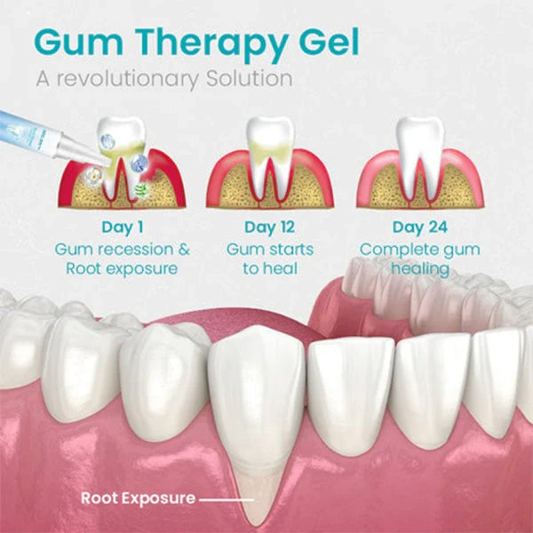 🔥Last Day Promotion 49% OFF-NESLEMY™ Gum Shield Therapy Gel（Buy 2 Free Shipping）