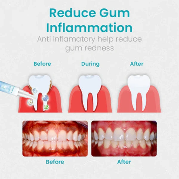 🔥Last Day Promotion 49% OFF-NESLEMY™ Gum Shield Therapy Gel（Buy 2 Free Shipping）