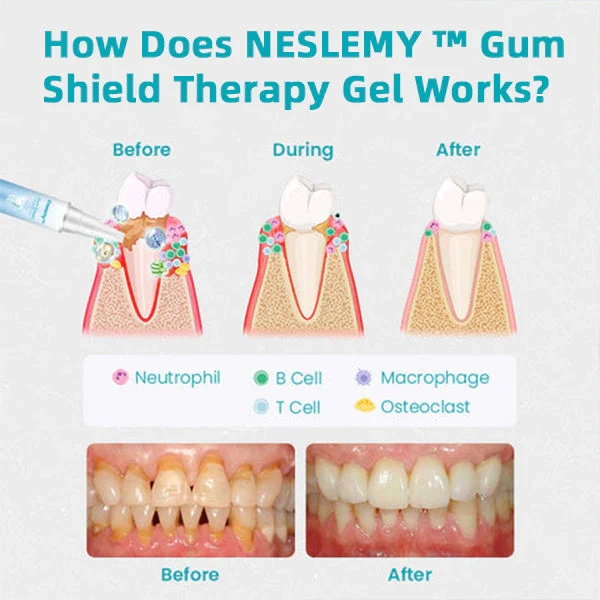 🔥Last Day Promotion 49% OFF-NESLEMY™ Gum Shield Therapy Gel（Buy 2 Free Shipping）