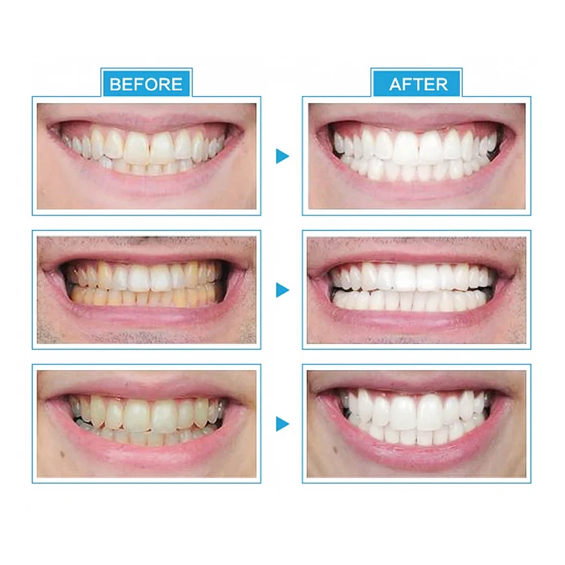 🔥🎁2024 Hot Sale🎁48% OFF-Teeth Whitening（Buy 2 Free Shipping）