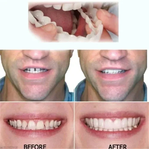 🔥🎁2024 Hot Sale🎁48% OFF - Adjustable Snap-On Dentures-Free Shipping🔥